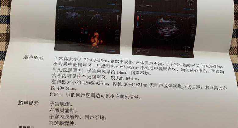 子宫肌瘤备孕(备孕期发现子宫肌瘤怎么办) 子宫肌瘤备孕(备孕期发现子宫肌瘤怎么办)