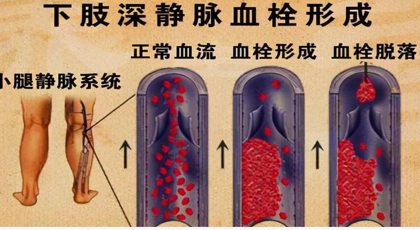 产后血栓(产后静脉血栓栓塞症) 产后血栓(产后静脉血栓栓塞症)