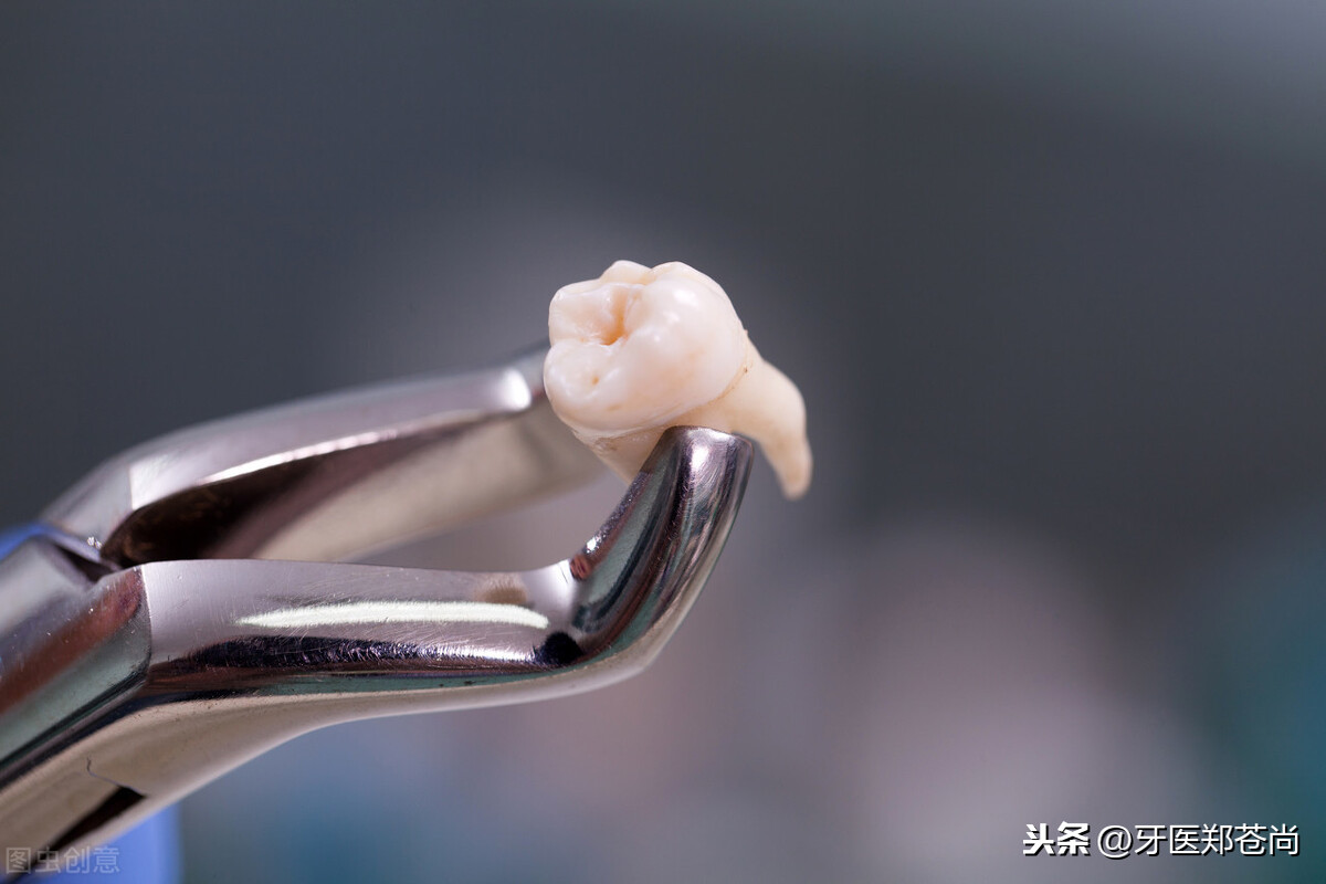 备孕拔智齿(备孕前一定要拔智齿吗) 备孕拔智齿(备孕前一定要拔智齿吗)