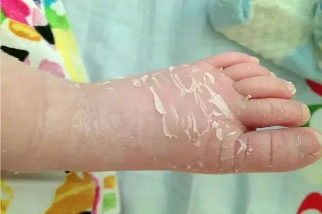 新生儿蜕皮(新生儿为什么会出现蜕皮) 新生儿蜕皮(新生儿为什么会出现蜕皮)