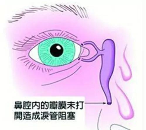 新生儿眼屎(新生儿眼屎多怎么办) 新生儿眼屎(新生儿眼屎多怎么办)