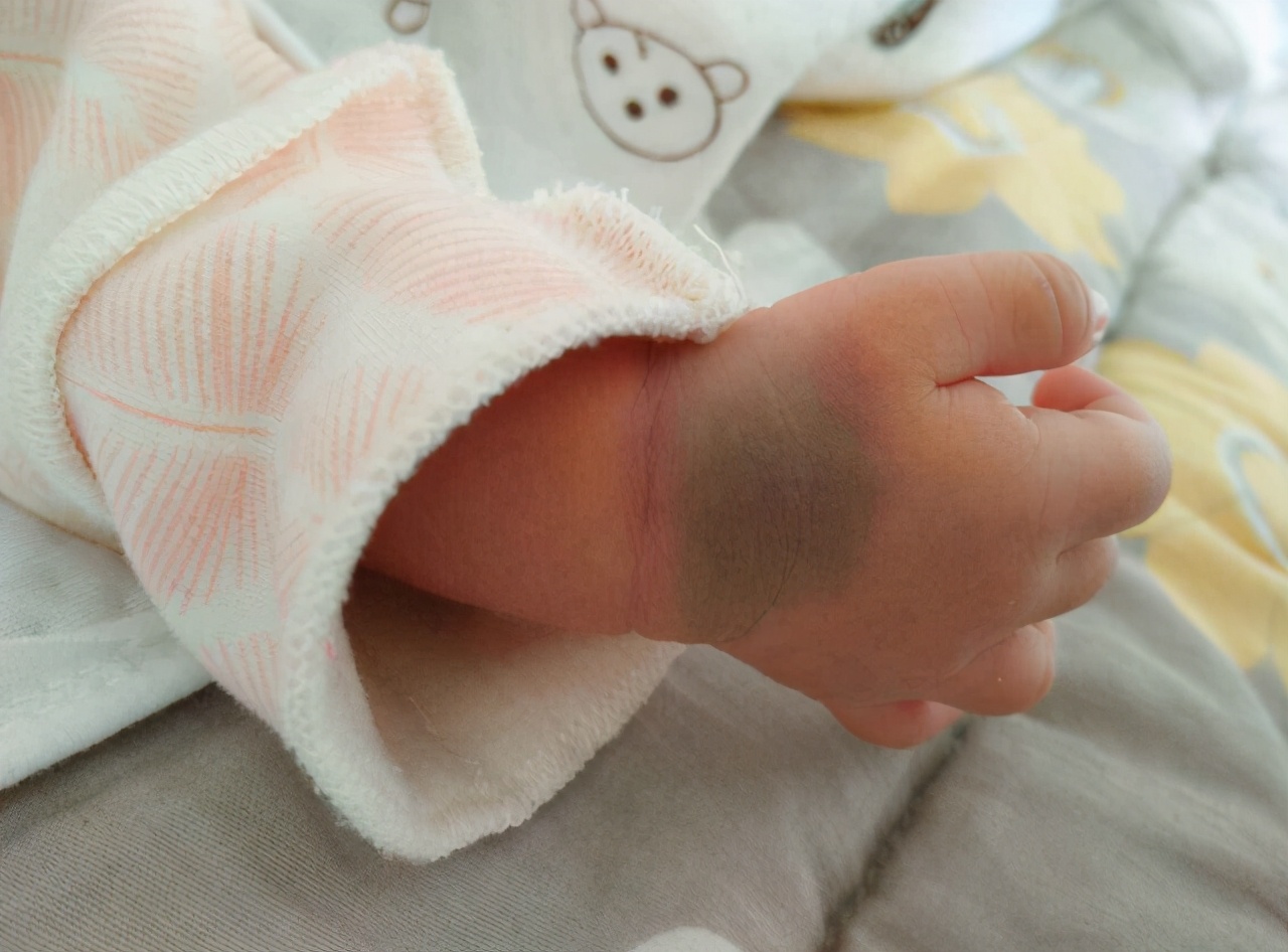 新生儿胎记(新生婴儿常见的7种胎记) 新生儿胎记(新生婴儿常见的7种胎记)