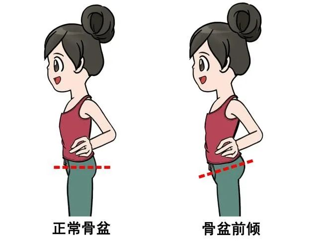 产后骨盆前倾的矫正方法 产后骨盆前倾的矫正方法