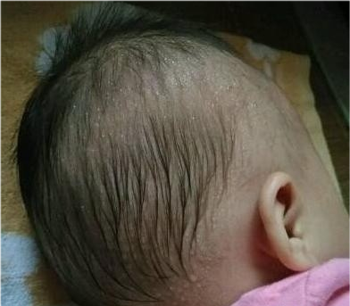 新生儿枕秃(小宝宝为什么会出现枕秃) 新生儿枕秃(小宝宝为什么会出现枕秃)