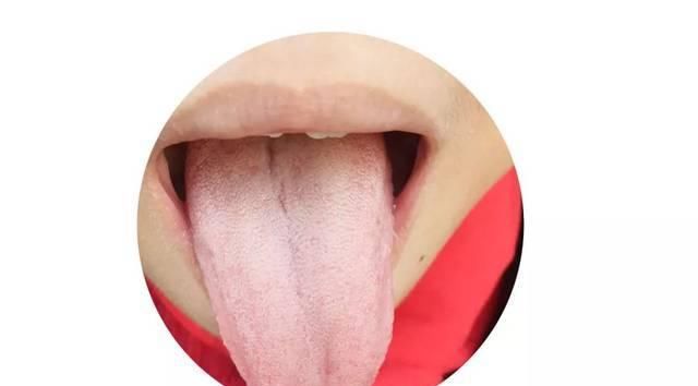 新生儿舌苔(教你学会看孩子舌苔) 新生儿舌苔(教你学会看孩子舌苔)