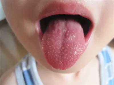 新生儿舌苔(教你学会看孩子舌苔) 新生儿舌苔(教你学会看孩子舌苔)