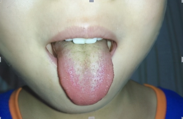 新生儿舌苔(教你学会看孩子舌苔) 新生儿舌苔(教你学会看孩子舌苔)
