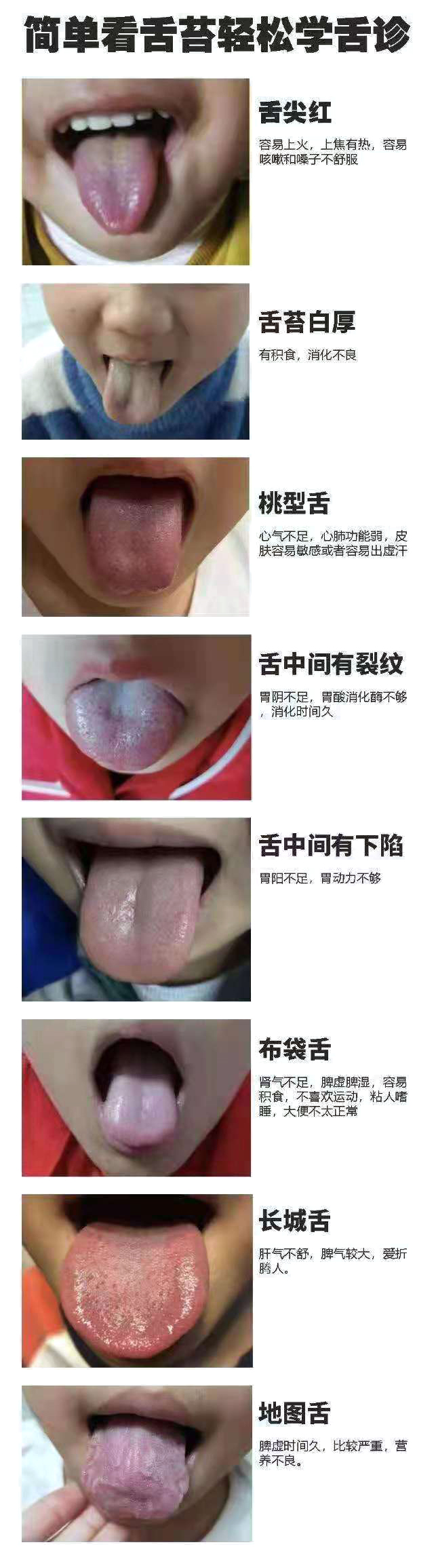 新生儿舌苔(教你学会看孩子舌苔) 新生儿舌苔(教你学会看孩子舌苔)