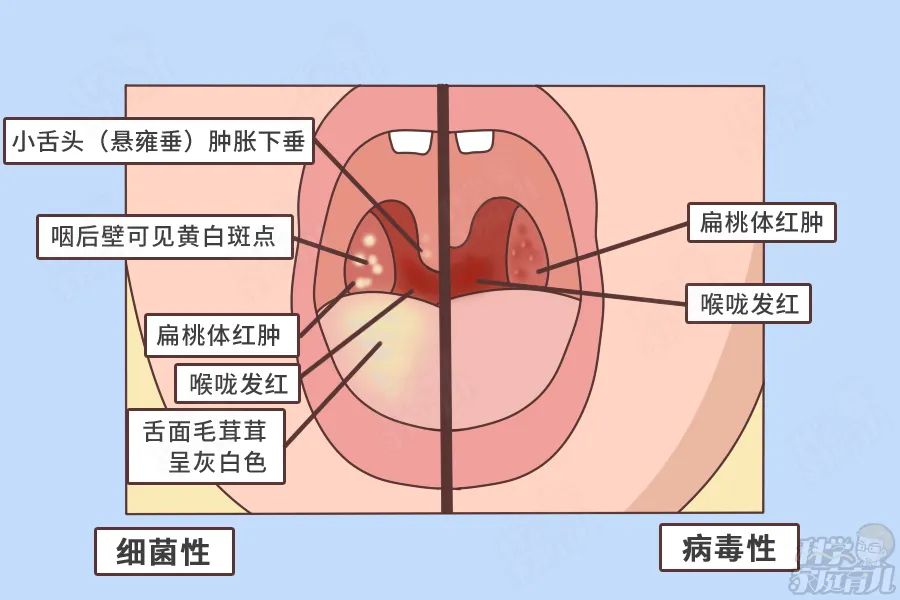 幼儿咽炎(幼儿急性咽炎) 幼儿咽炎(幼儿急性咽炎)