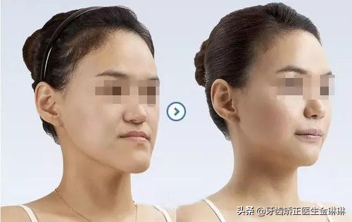 备孕能整牙吗(备孕期可以整牙吗) 备孕能整牙吗(备孕期可以整牙吗)