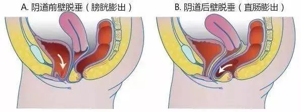 产后阴壁膨出(产后阴壁膨出是什么怎么治疗) 产后阴壁膨出(产后阴壁膨出是什么怎么治疗)