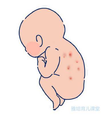 新生儿栗粒疹(新生儿粟粒疹是什么引起的)