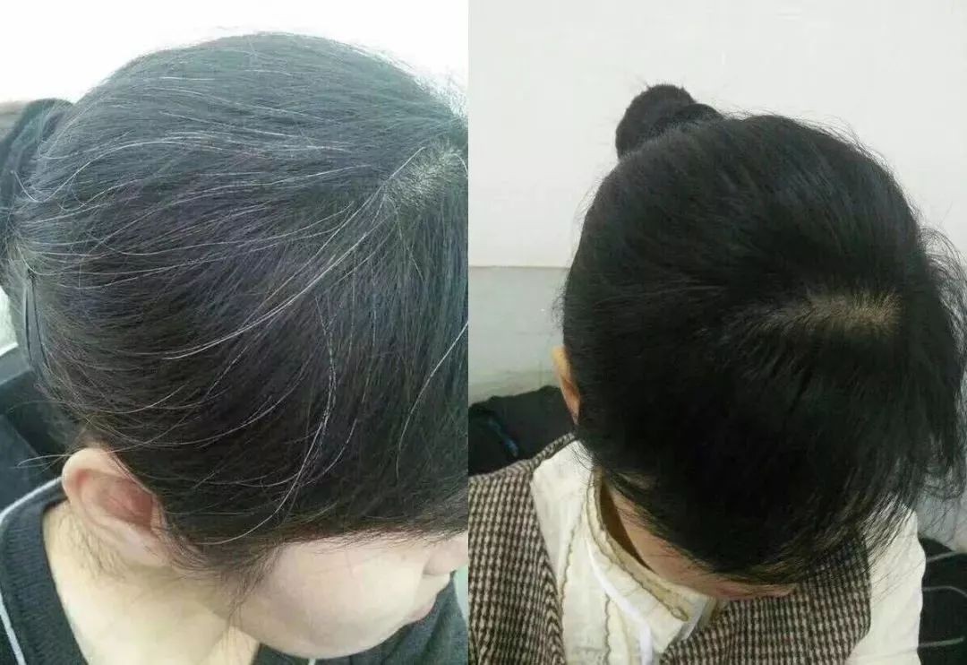 幼儿白头发是什么原因(两鬓白头发是什么原因引起的) 幼儿白头发是什么原因(两鬓白头发是什么原因引起的)